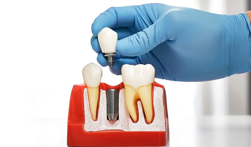 dental implants in Murfreesboro, TN, dental implants near me